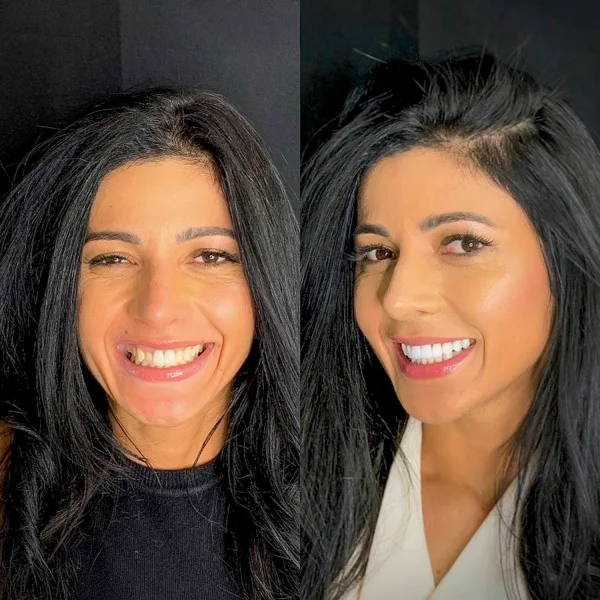 Paciente da Dentis Elo, antes e depois das lentes de contato dental em Ribeirão Preto